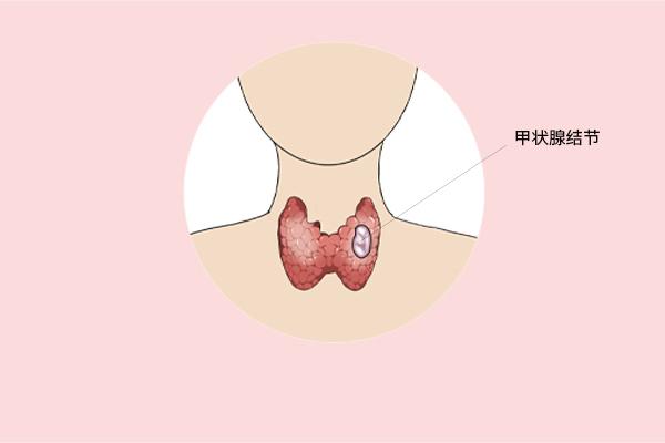 甲狀腺癌癥的主要癥狀表現(xiàn)有什么？為什么會得甲狀腺癌癥呢？