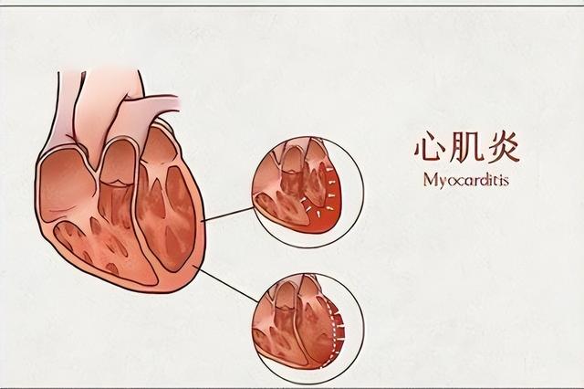 心肌炎的癥狀有哪些？心肌炎的主要變現(xiàn)癥狀有啥？